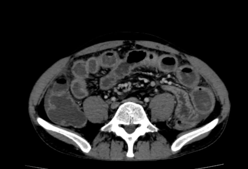 Behçet's disease- abdominal vasculitis (Radiopaedia 55955-62570 A 56).jpg