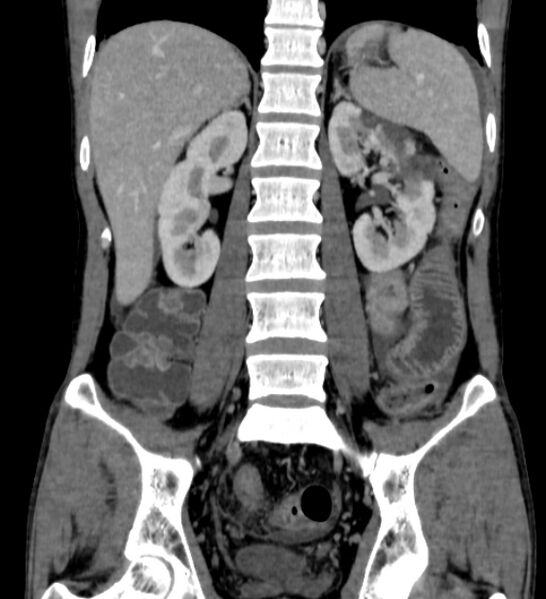 File:Behçet's disease- abdominal vasculitis (Radiopaedia 55955-62570 B 39).jpg