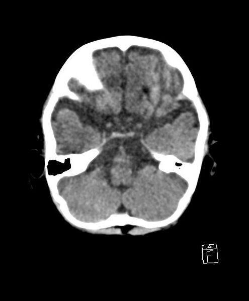 File:Benign enlargement of subarachnoid spaces in infancy (BESS) (Radiopaedia 87459-103795 Axial non-contrast 68).jpg