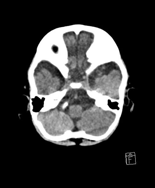 File:Benign enlargement of subarachnoid spaces in infancy (BESS) (Radiopaedia 87459-103795 Axial non-contrast 70).jpg