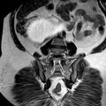 Benign seromucinous cystadenoma of the ovary (Radiopaedia 71065-81300 F 24).jpg