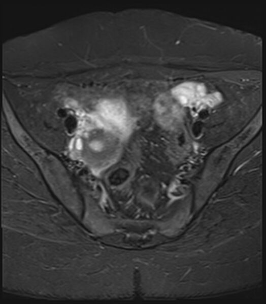 File:Bicornuate, unicollis uterus (Radiopaedia 79468-92593 Axial STIR 6).jpg