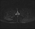 Bicornuate bicollis uterus (Radiopaedia 61626-69616 Axial PD fat sat 37).jpg