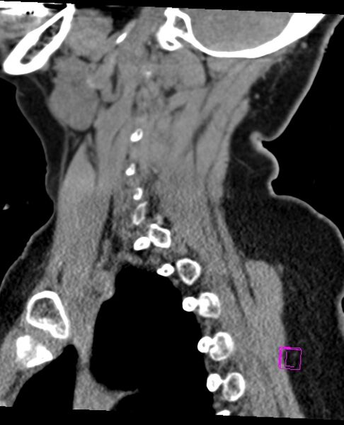 File:Bilateral atlanto-occipital assimilation (Radiopaedia 28350-28603 D 58).jpg
