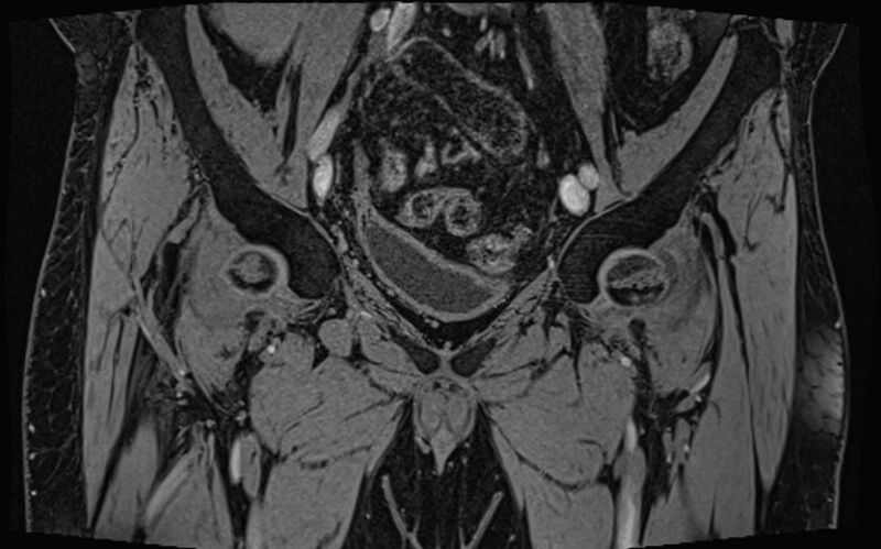 File:Bilateral avascular necrosis of femoral head (Radiopaedia 77116-89078 Coronal T2 we 70).jpg