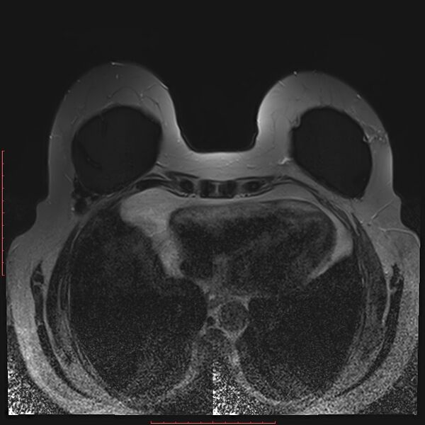 File:Bilateral breast implant rupture (Radiopaedia 24761-25027 T2 fat sat 27).jpg