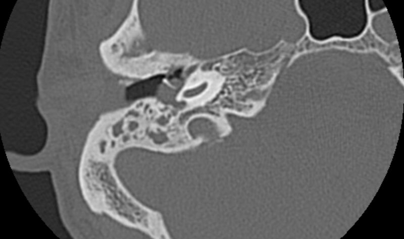 File:Bilateral cholesteatoma (Radiopaedia 54898-61172 Axial bone window 17).jpg