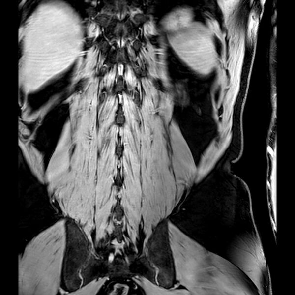 File:Bilateral conjoined nerve roots at different levels (Radiopaedia 73312-84063 B 43).jpg