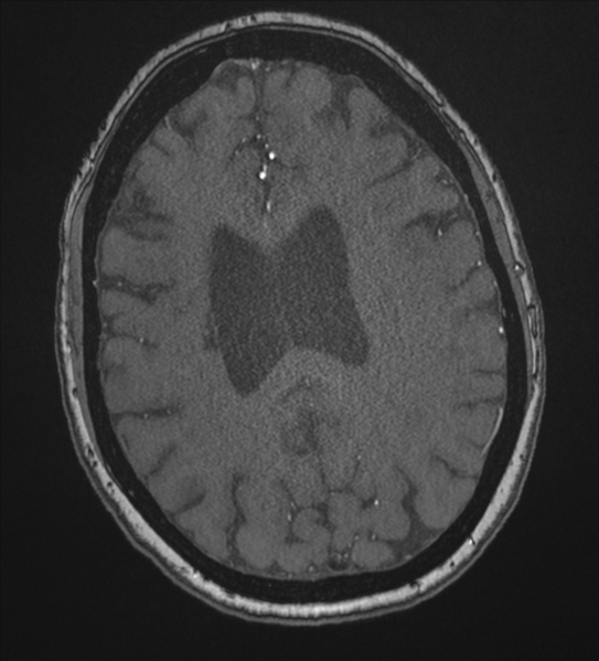 File:Bilateral fetal posterior communicating arteries (Radiopaedia 41286-44102 Axial MRA 152).png