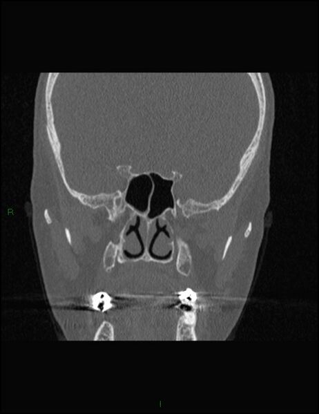 File:Bilateral frontal mucoceles (Radiopaedia 82352-96454 Coronal 200).jpg