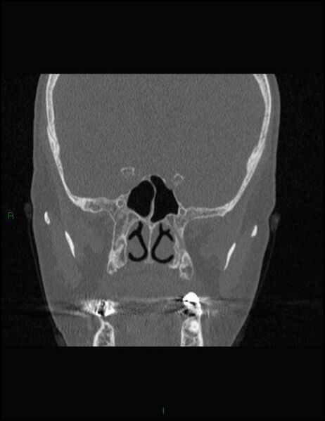 File:Bilateral frontal mucoceles (Radiopaedia 82352-96454 Coronal 206).jpg
