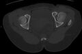 Bilateral mature cystic ovarian teratoma (Radiopaedia 88821-105592 Axial bone window 43).jpg