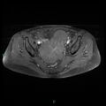 Bilateral ovarian fibroma (Radiopaedia 44568-48293 Axial T1 C+ fat sat 14).jpg