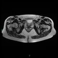 Bilateral ovarian fibroma (Radiopaedia 44568-48293 Axial T2 24).jpg