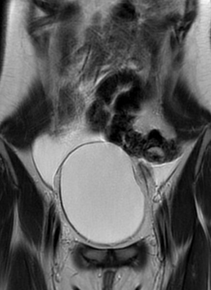 File:Bilateral ovarian fibrothecomas - adolescent (Radiopaedia 86604-102707 Coronal T2 9).jpg