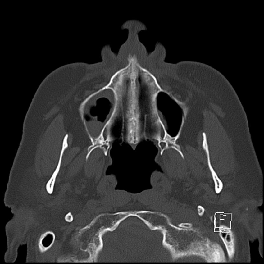 Bilateral palatine tonsilloliths on OPG and CT (Radiopaedia 75167-86247 Axial bone window 28).jpg