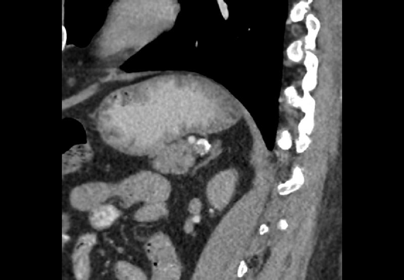 File:Bilateral urolithiasis with incidentally detected splenic artery aneurysm and left inferior vena cava (Radiopaedia 44467-48127 Ob. Sag. C+ Art. 31).jpg