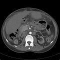 Biliary necrosis - liver transplant (Radiopaedia 21876-21846 A 31).jpg