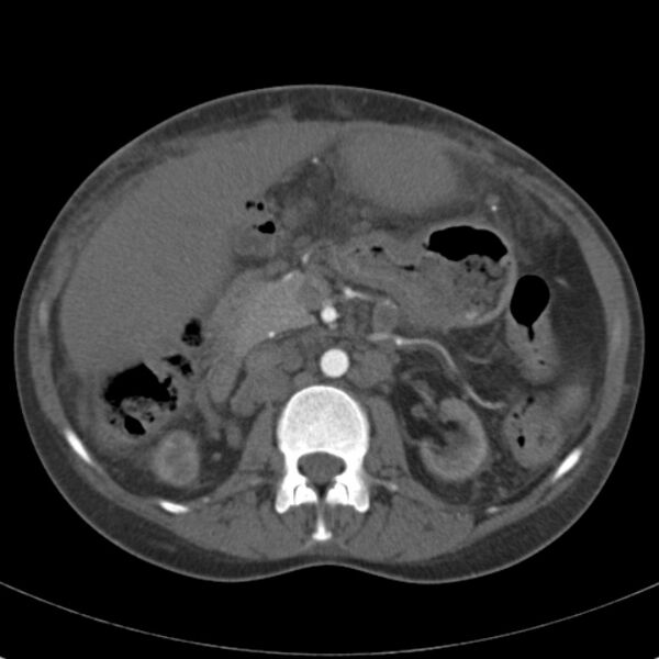 File:Biliary necrosis - liver transplant (Radiopaedia 21876-21846 A 31).jpg