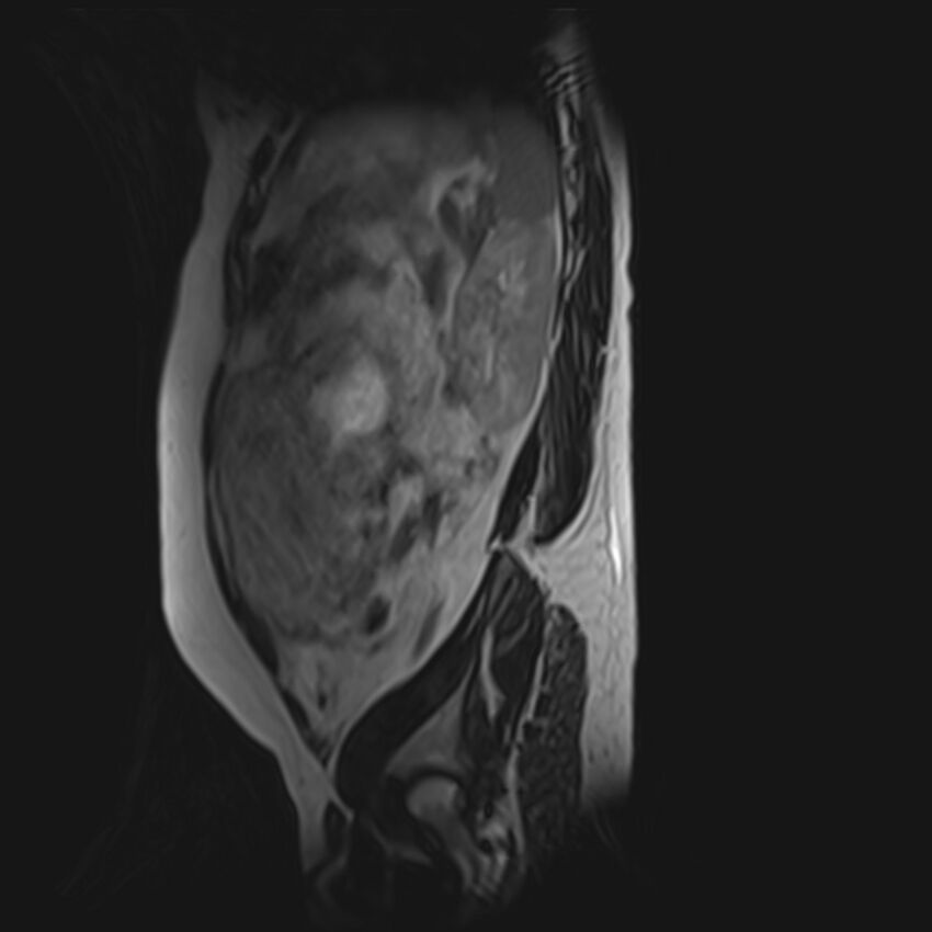 Bilobed placenta accreta (Radiopaedia 69648-79591 G 12).jpg