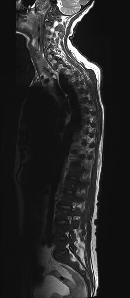 File:Bing-Neel syndrome (Radiopaedia 71453-81799 Sagittal T2 2).jpg