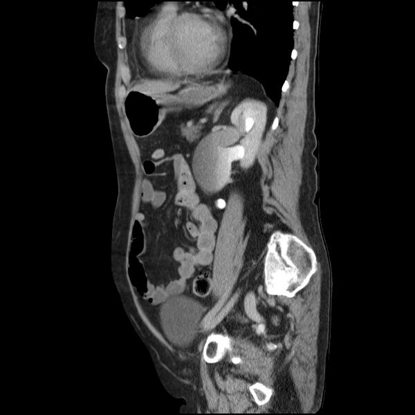 File:Bladder tumor detected on trauma CT (Radiopaedia 51809-57609 E 25).jpg