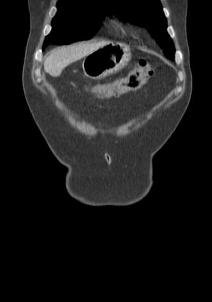File:Bleeding duodenal ulcer and adenomyomatosis of gallbladder (Radiopaedia 61834-69861 B 78).jpg