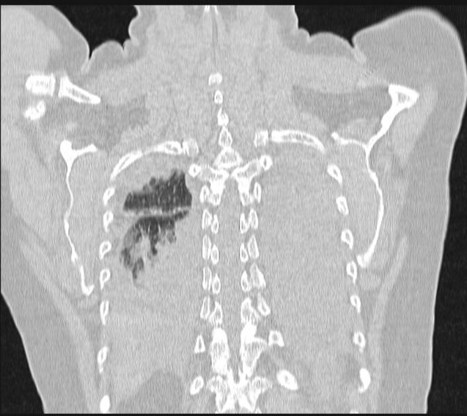 File:Boerhaave syndrome (Radiopaedia 45644-49799 Coronal lung window 58).jpg
