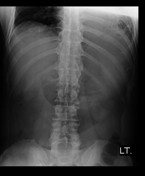 File:Boerhaave syndrome (Radiopaedia 59796-67313 C 1).jpg