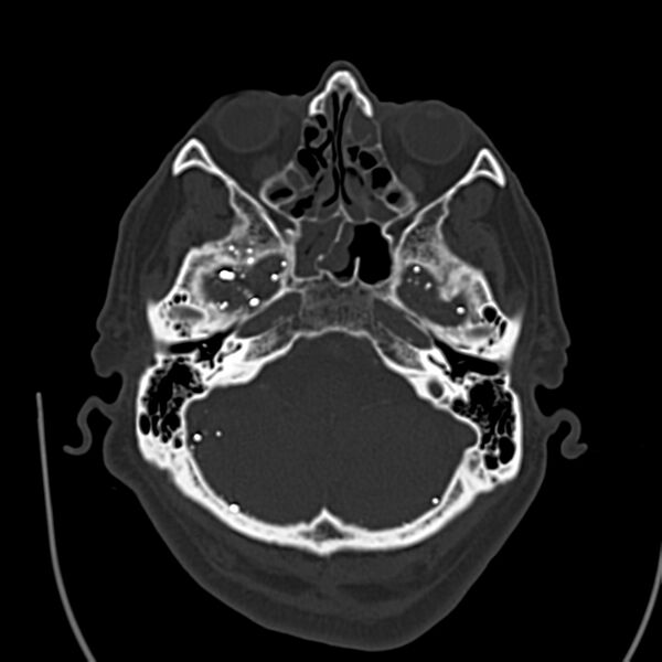 File:Brain Pantopaque remnants (Radiopaedia 78403-91048 Axial bone window 21).jpg