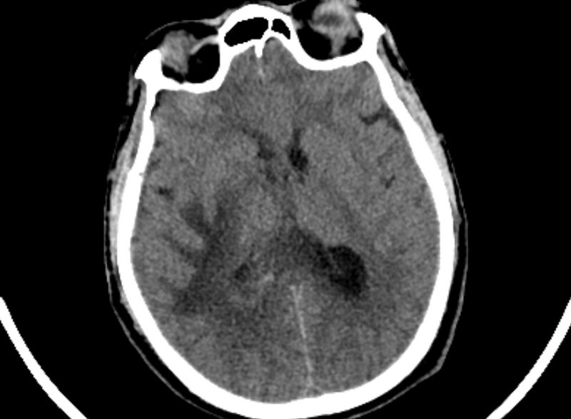 File:Brain abscess complicated by intraventricular rupture and ventriculitis (Radiopaedia 82434-96575 Axial non-contrast 47).jpg