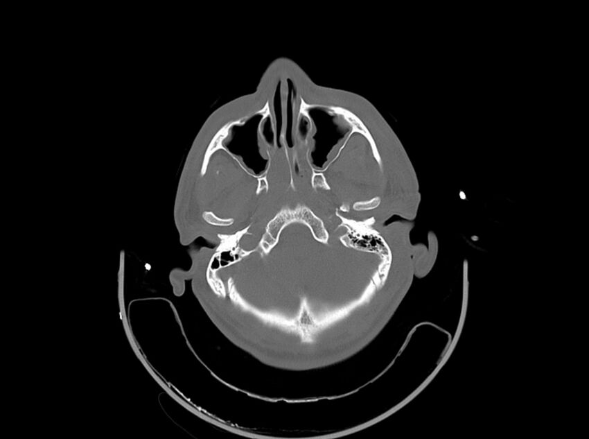 Brain injury by firearm projectile (Radiopaedia 82068-96087 A 53).jpg