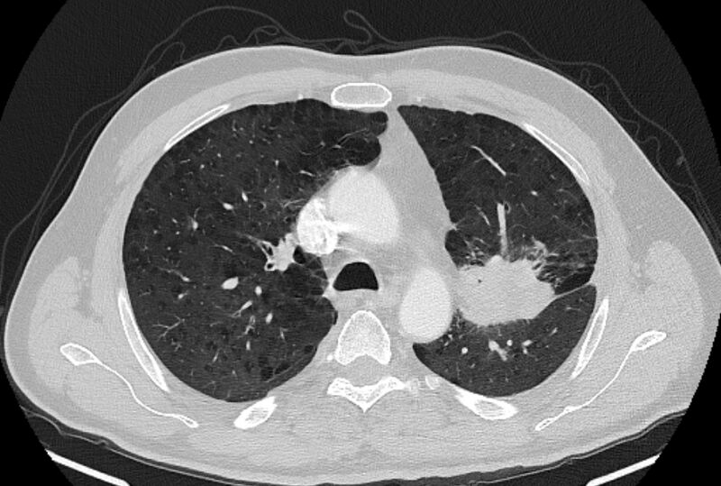 File:Brain metastases - lung cancer primary (Radiopaedia 75060-86116 Axial lung window 19).jpg