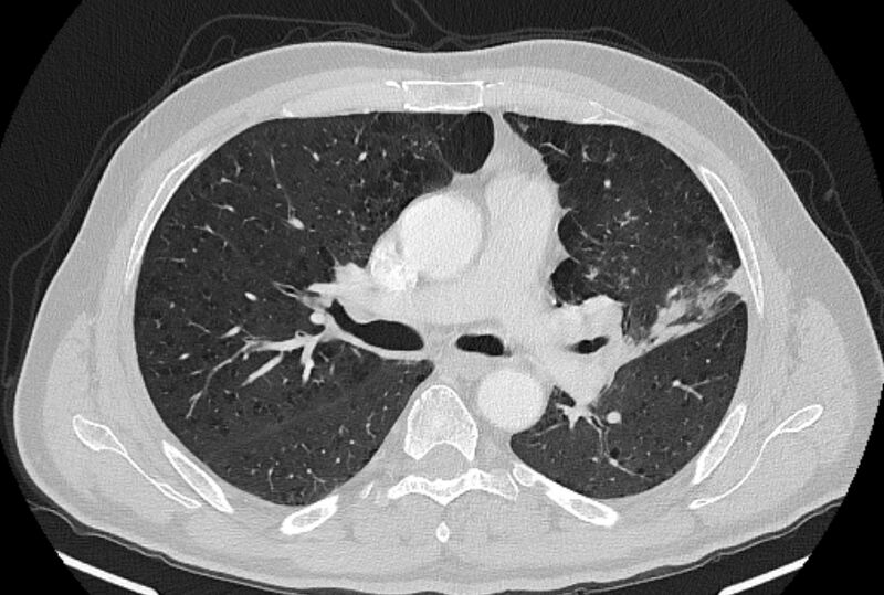 File:Brain metastases - lung cancer primary (Radiopaedia 75060-86116 Axial lung window 24).jpg