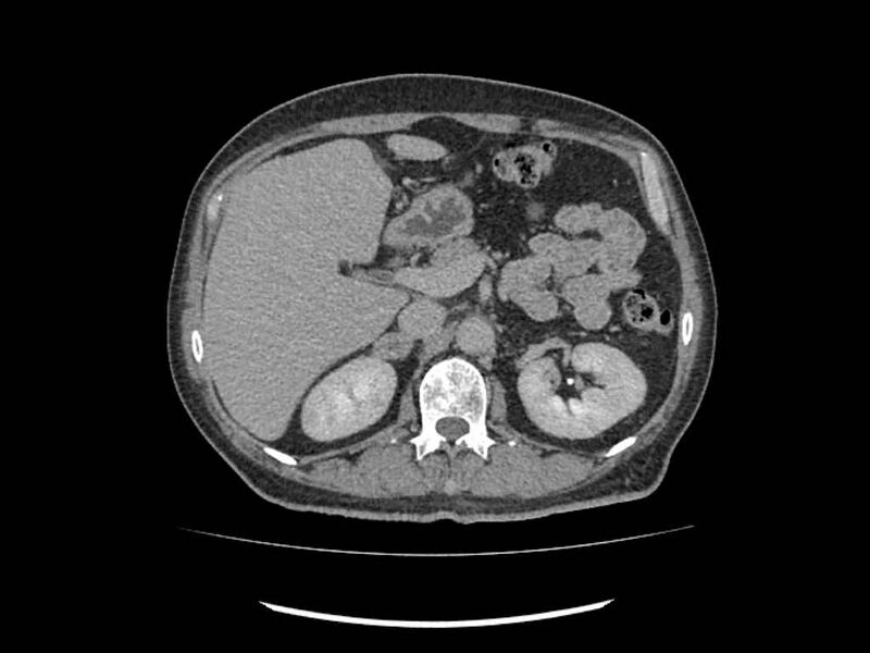 File:Brain metastases from renal cell carcinoma (Radiopaedia 42222-45328 Axial C+ delayed 55).jpg