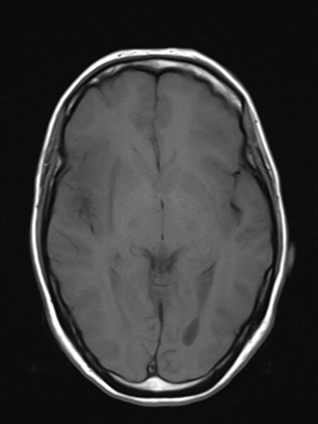 File:Brain metastasis as initial presentation of non-small cell lung cancer (Radiopaedia 65122-74126 Axial T1 10).jpg