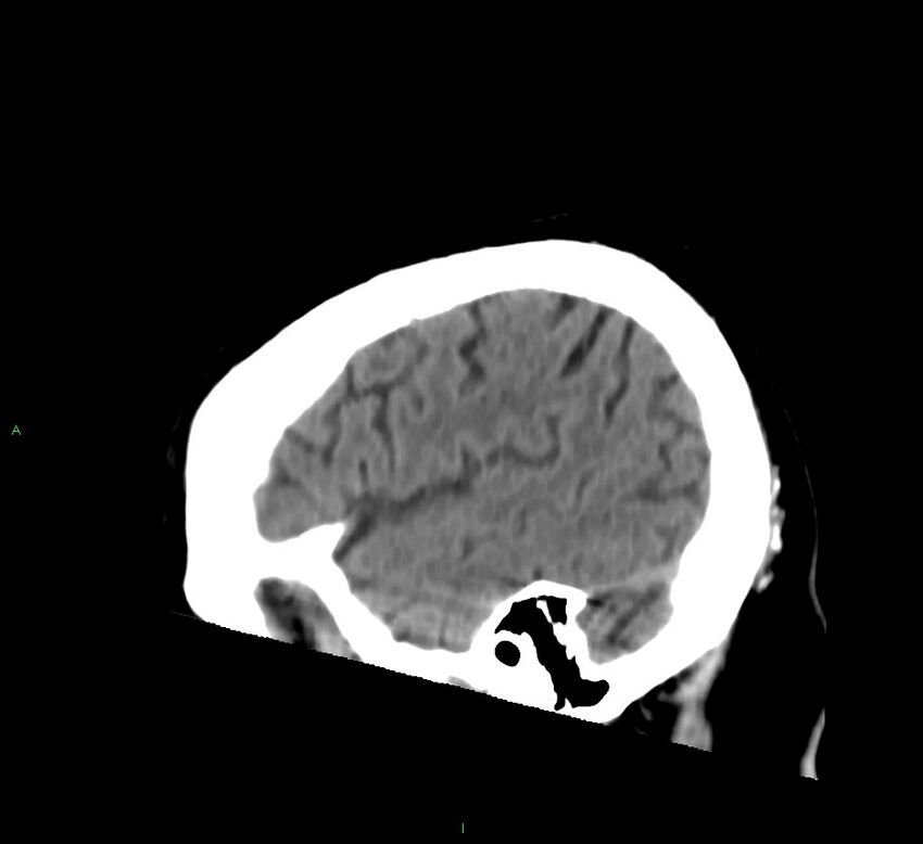 Brainstem hemorrhage (Radiopaedia 58794-66028 C 42).jpg