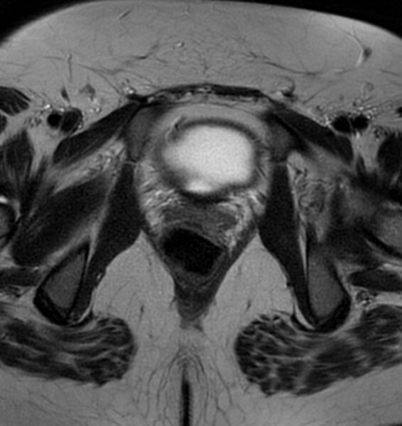 File:Broad ligament leiomyoma (Radiopaedia 81634-95516 Axial T2 23).jpg