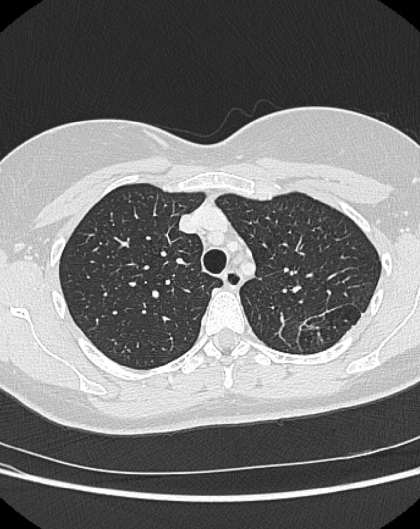Bronchial atresia (Radiopaedia 50007-55297 Axial lung window 24).jpg