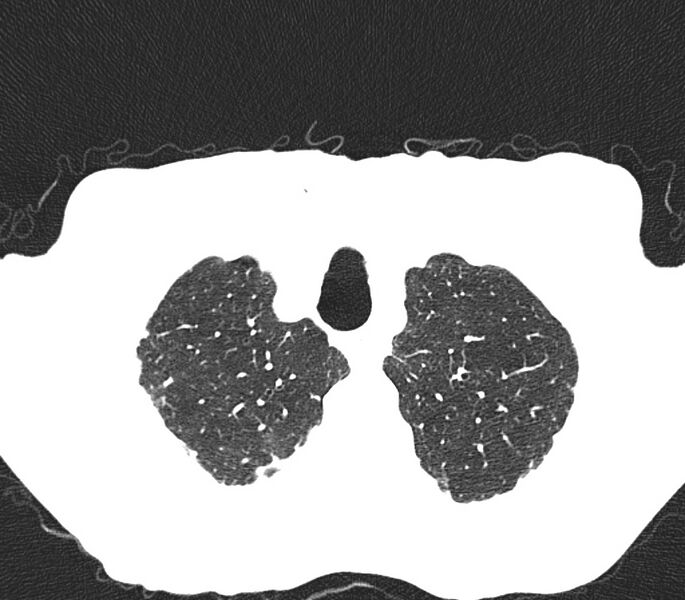 File:Bronchiolitis (Radiopaedia 24616-24887 Axial lung window 4).jpg