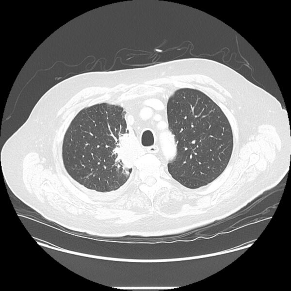 File:Bronchogenic adenocarcinoma and pulmonary embolism (Radiopaedia 9097-9806 Axial lung window 7).jpg