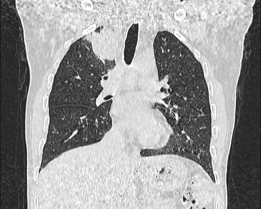 Bronchogenic carcinoma with superior vena cava syndrome (Radiopaedia 36497-38054 Coronal lung window 34).jpg