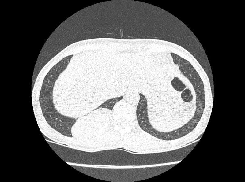 File:Bronchogenic cyst (Radiopaedia 80273-93615 Axial lung window 33).jpg