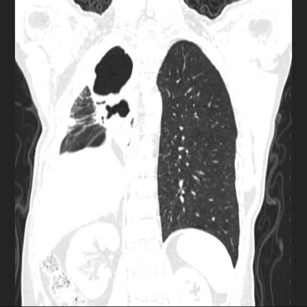 File:Bronchopleural fistula - postoperative complication (Radiopaedia 21020-20947 Coronal lung window 19).jpg