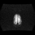 Burkitt lymphoma of the orbit- pre and post chemotherapy (Radiopaedia 31214-31929 Axial DWI 16).jpg