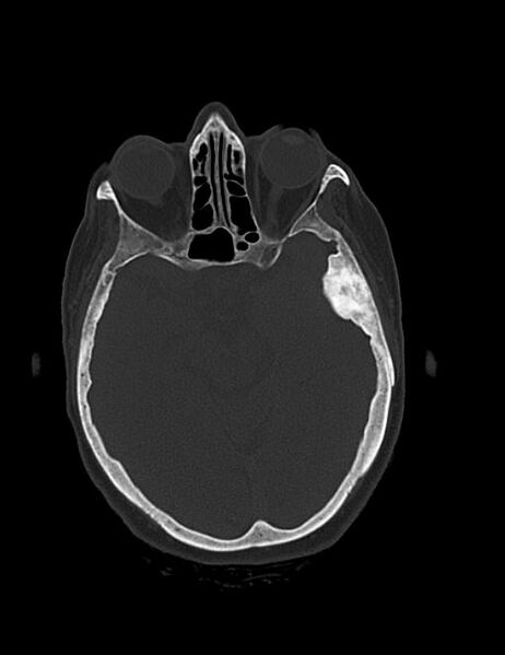 File:Burnt-out meningioma (Radiopaedia 51557-57337 Axial bone window 19).jpg