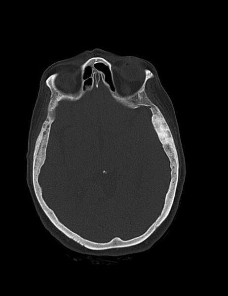 File:Burnt-out meningioma (Radiopaedia 51557-57337 Axial bone window 22).jpg