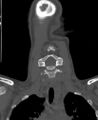 Butterfly vertebra (Radiopaedia 77903-90209 Coronal bone window 15).jpg