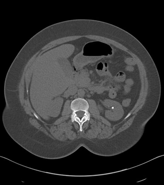 File:Calcified hepatic hydatid cyst (Radiopaedia 81127-94738 Axial non-contrast 39).jpg