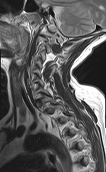 File:Calcified meningioma - cervical canal (Radiopaedia 70136-82468 Sagittal T2 11).jpg